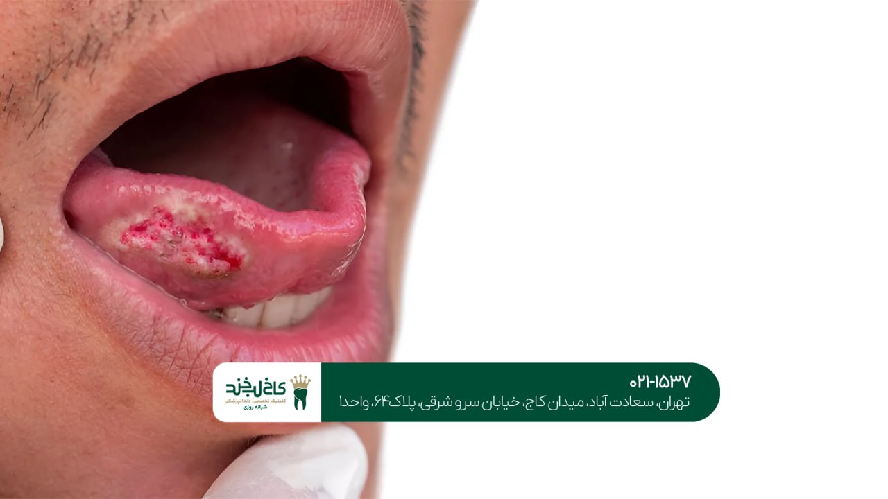 درمانهای ضد عفونی دهان و دندان