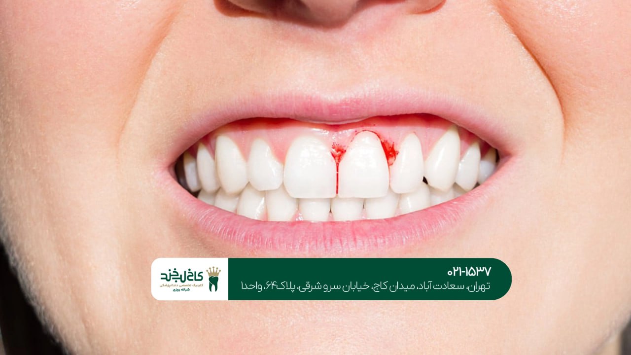 درمان دندانهای حساس