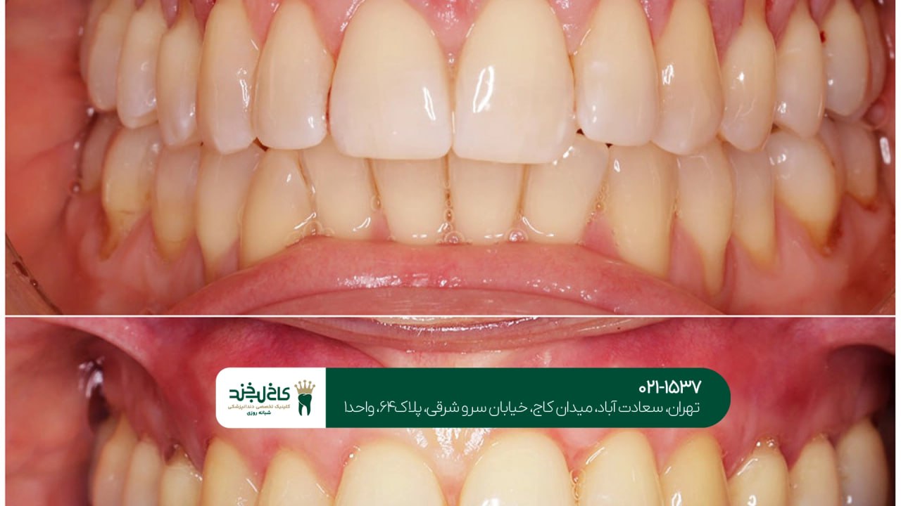 جراحی پلاستیک لثه