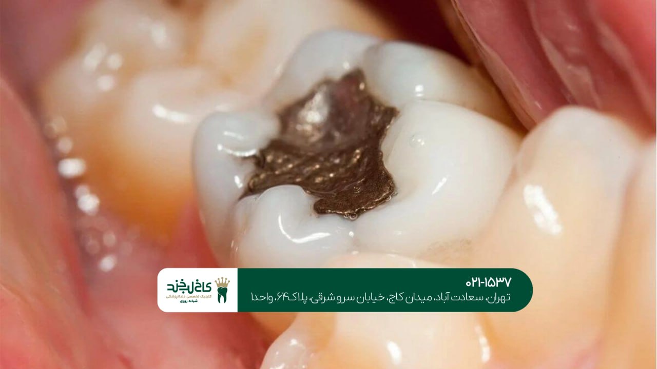 درمان پوسیدگی شدید دندان