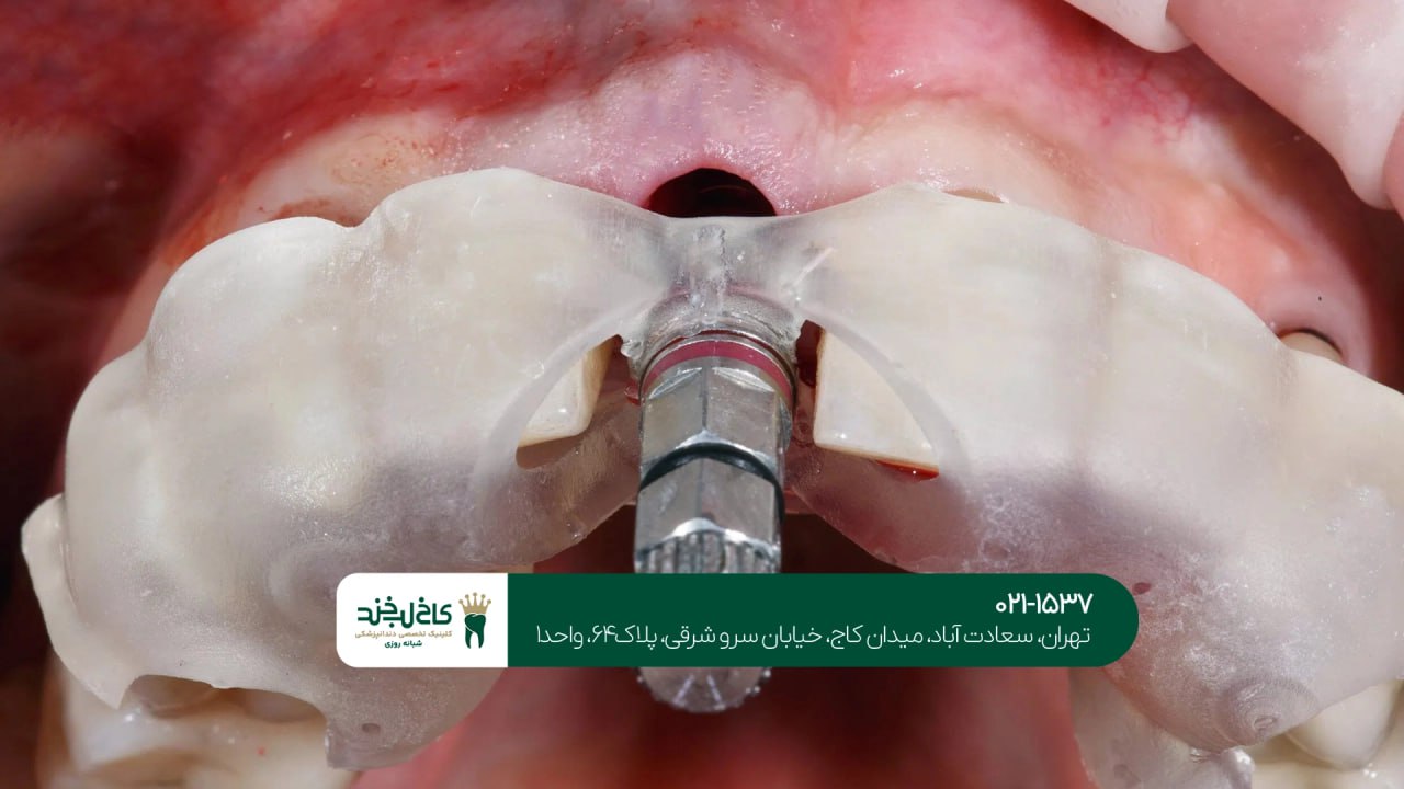 درمانهای تخصصی ایمپلنت