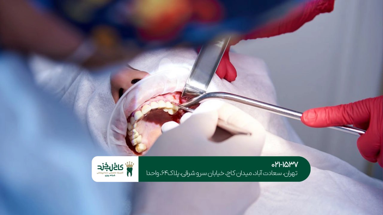 جراحی دندان عقل
