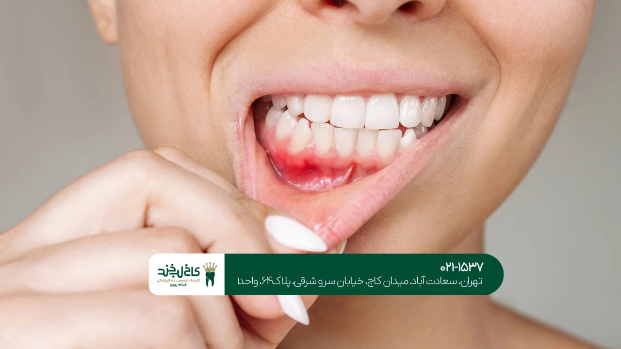 درمان لثه در تهران
