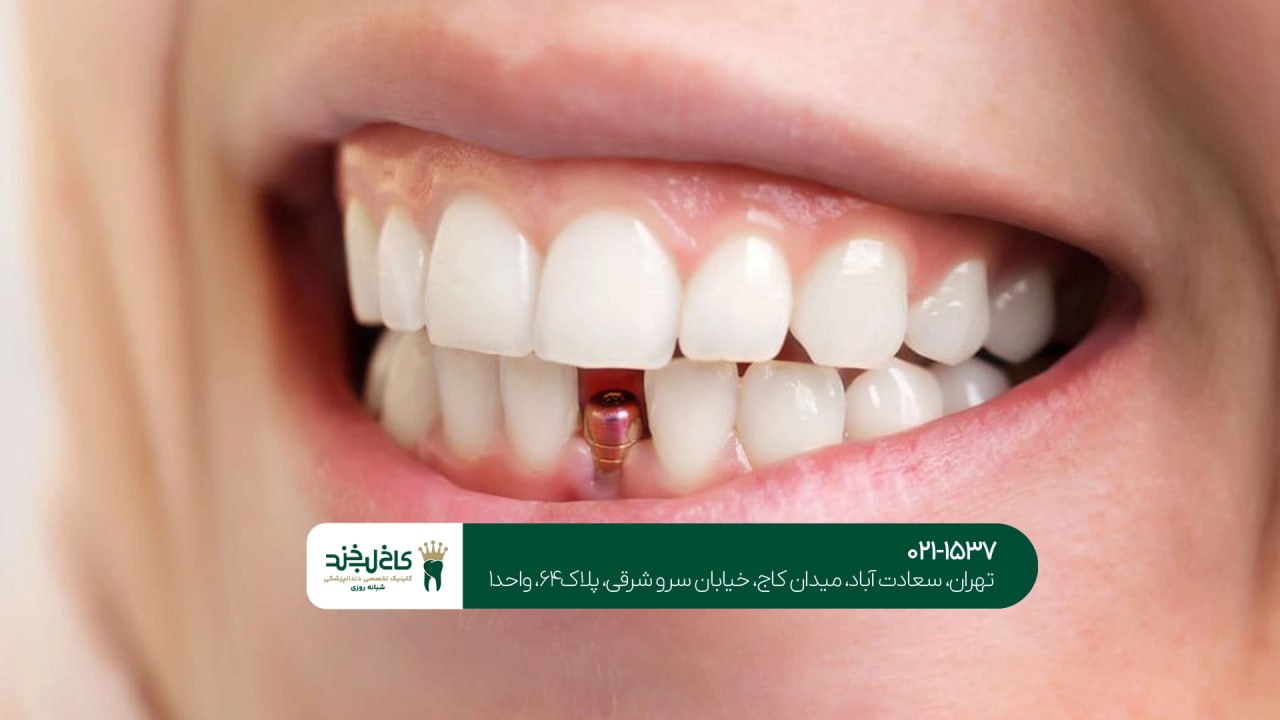 ایمپلنت دندان یک روزه