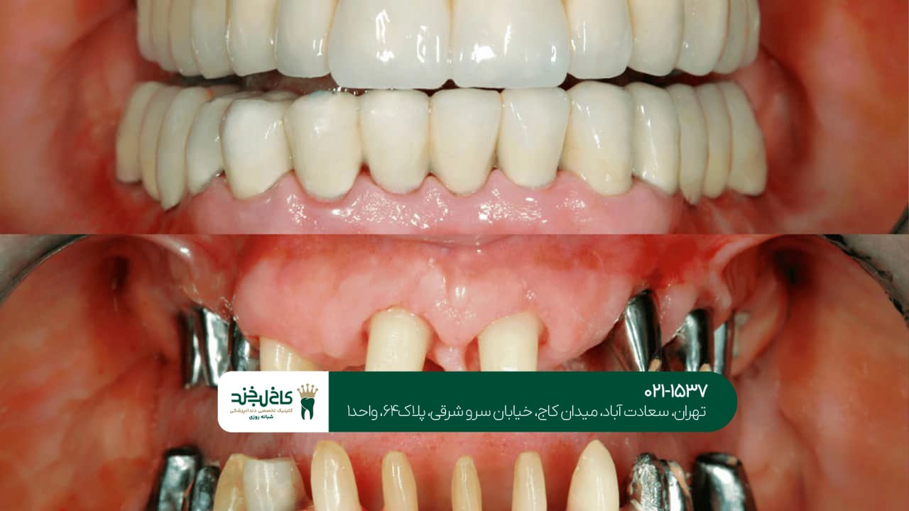 بهترین ایمپلنت دندان در تهران