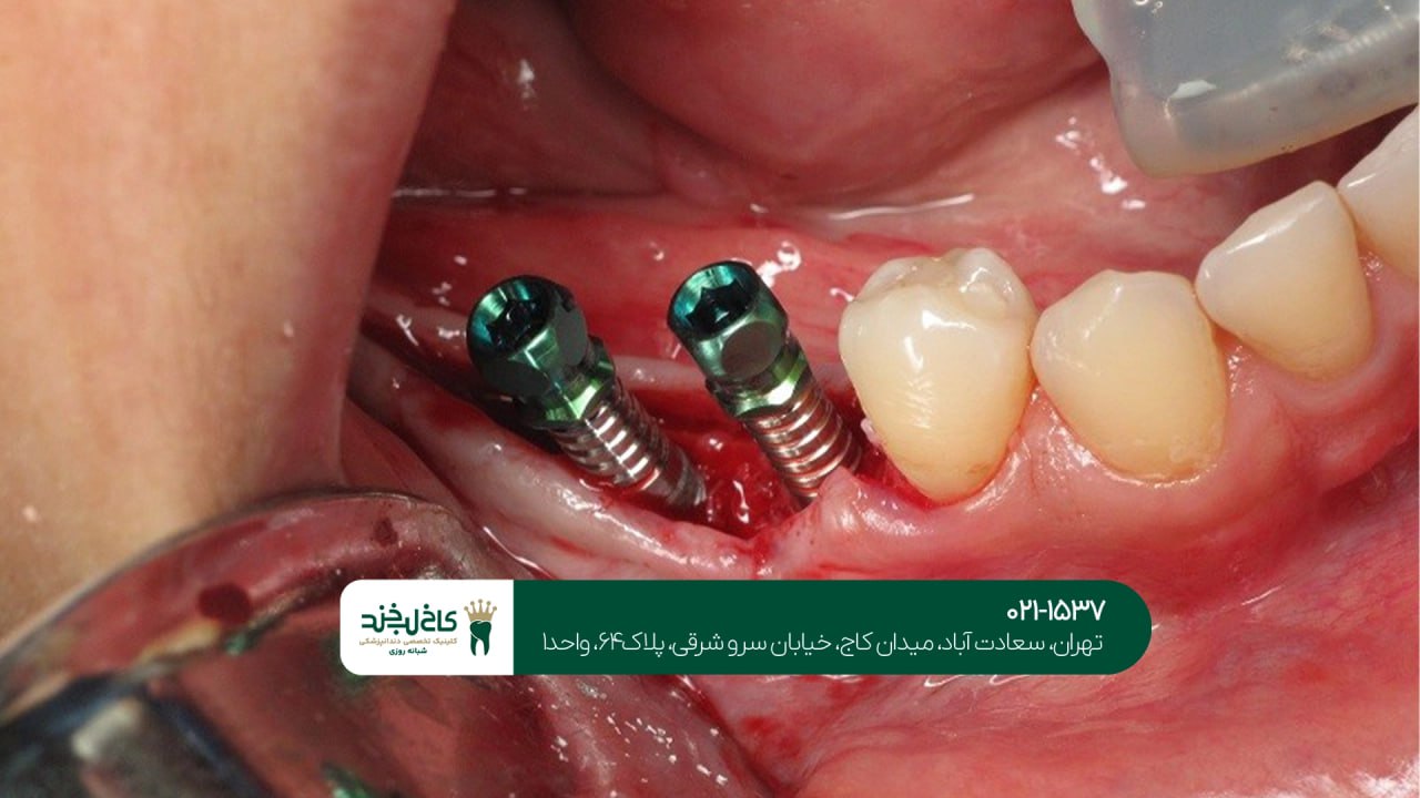 مشاوره ایمپلنت دندان