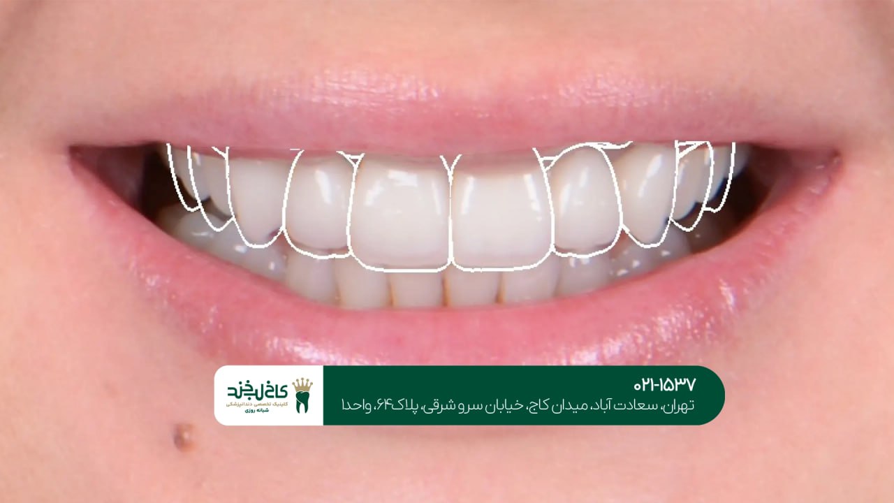 طراحی لبخند