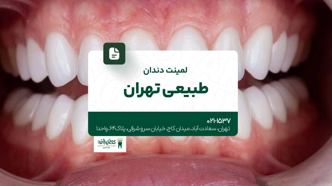 لمینت دندان طبیعی در تهران