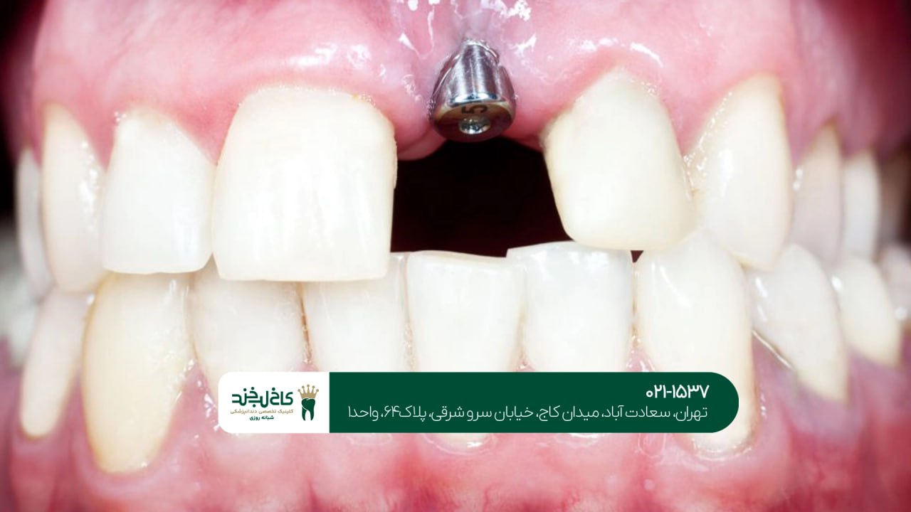 مرکز ایمپلنت سعادت آباد