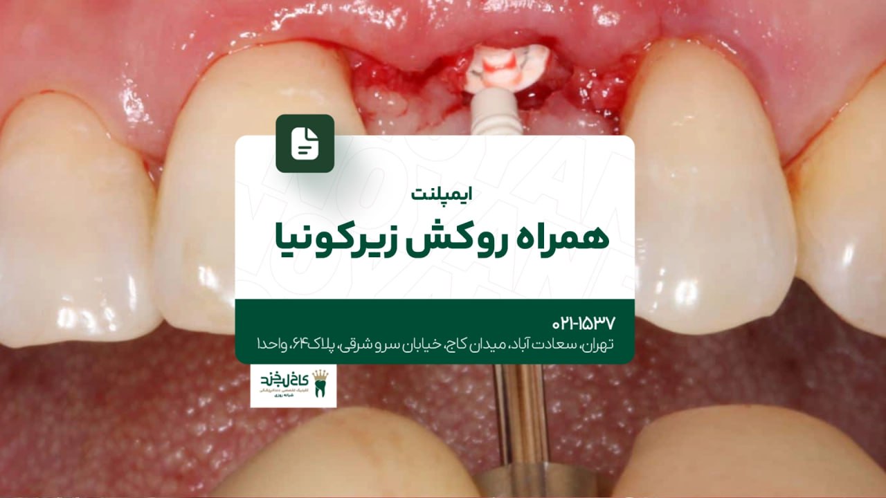 ایمپلنت همراه روکش زیرکونیا