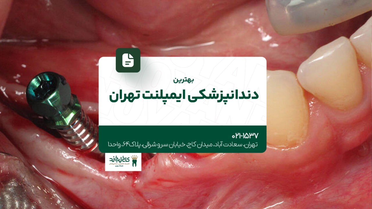 بهترین دندانپزشکی ایمپلنت تهران