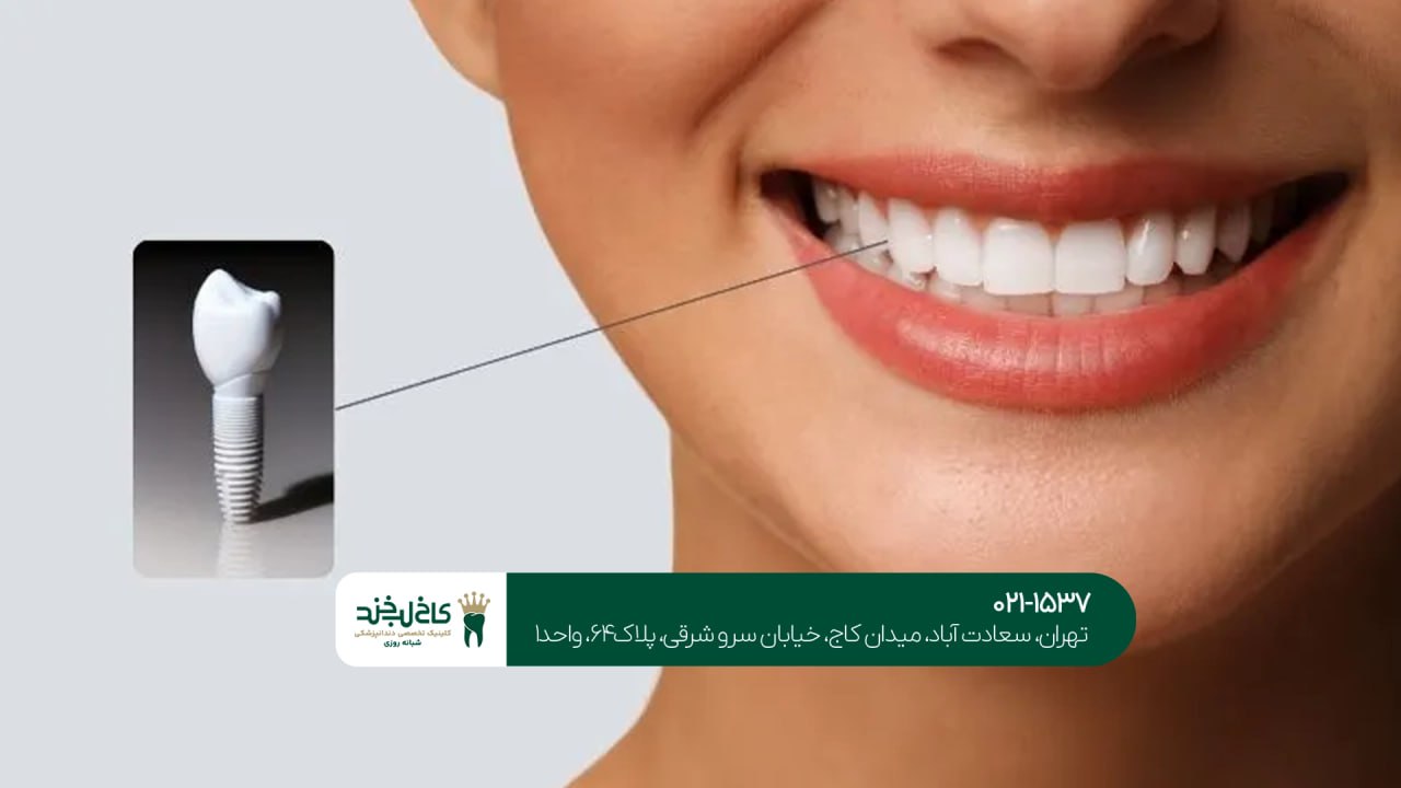 ایمپلنت برای زیبایی