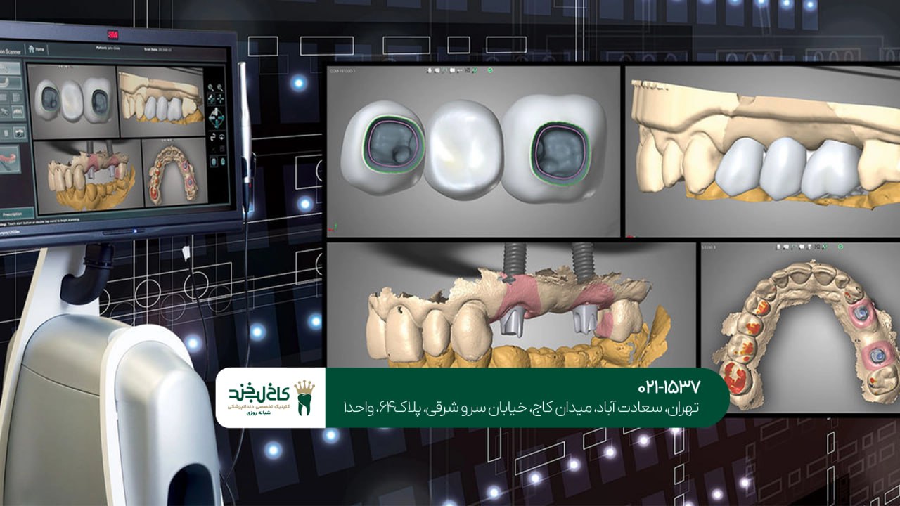 ایمپلنت دیجیتال پیشرفته