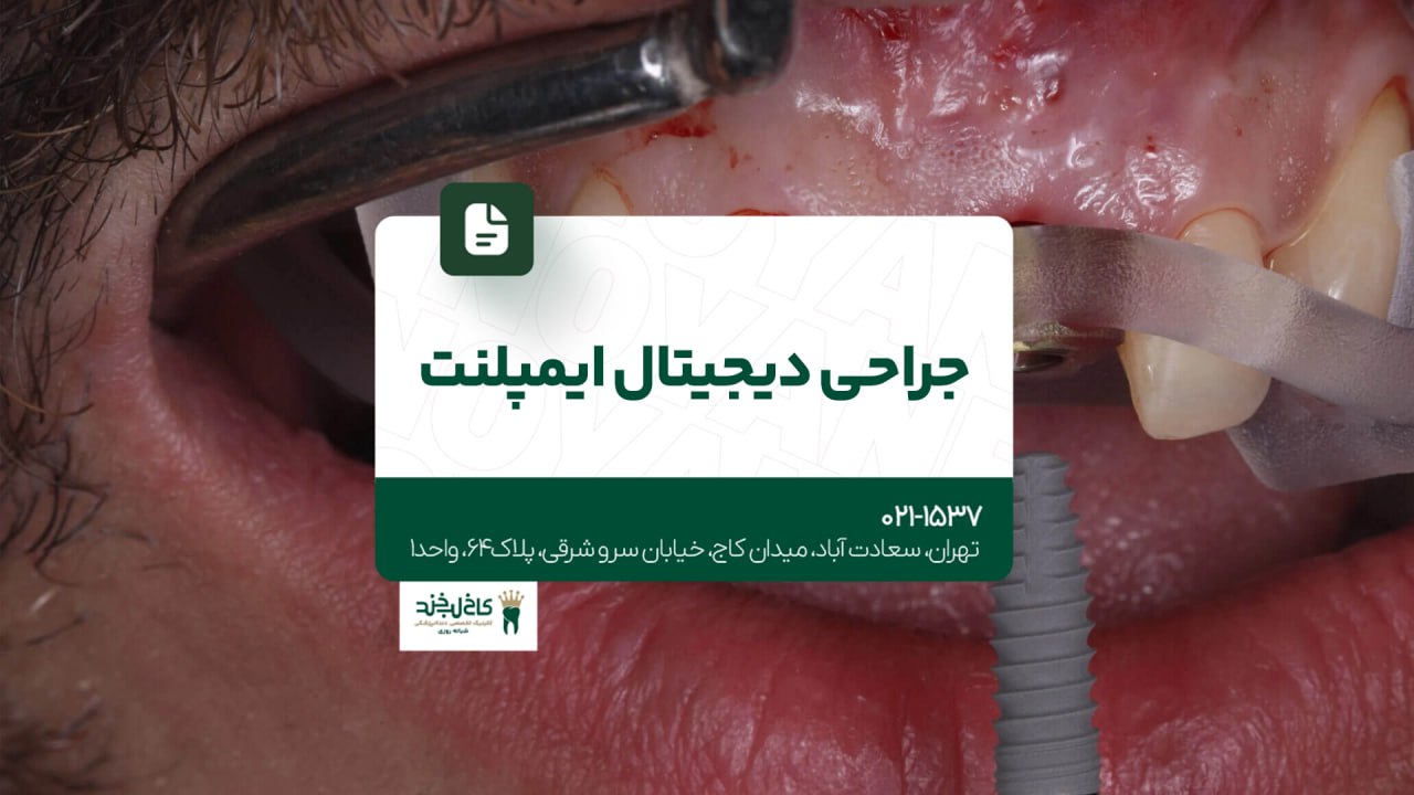 جراحی دیجیتال ایمپلنت