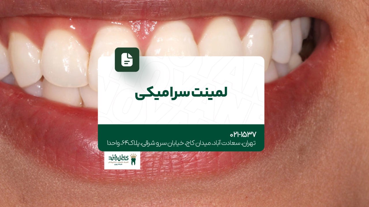 لمینت سرامیکی