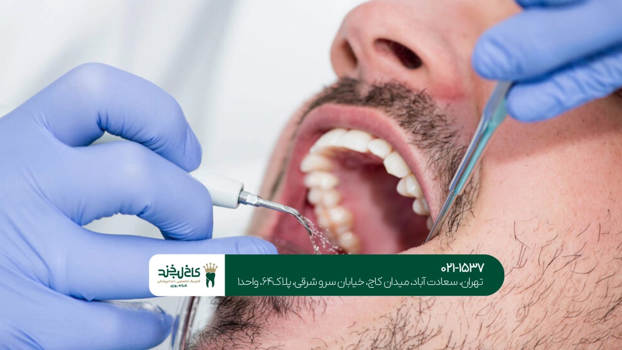 آیا جرمگیری به دندان آسیب می زند؟آیا جرمگیری به دندان آسیب می زند؟