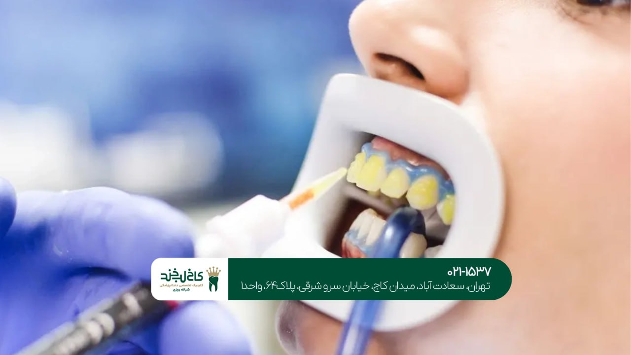 سفید کردن دندان حرفهای