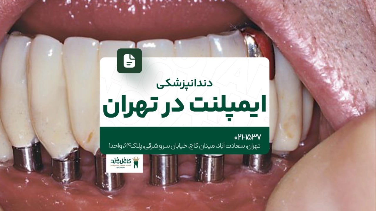 دندانپزشکی ایمپلنت در تهران