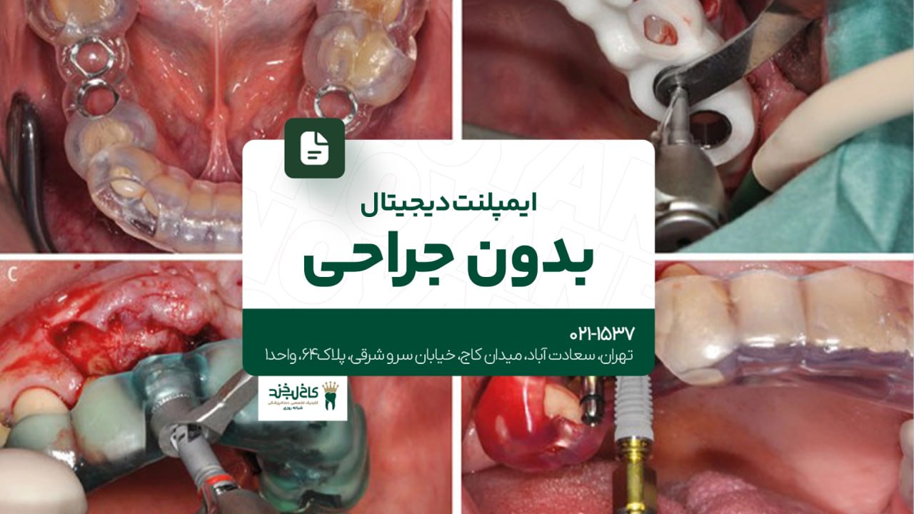 ایمپلنت دیجیتال بدون جراحی