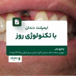 ایمپلنت دندان با تکنولوژی روز