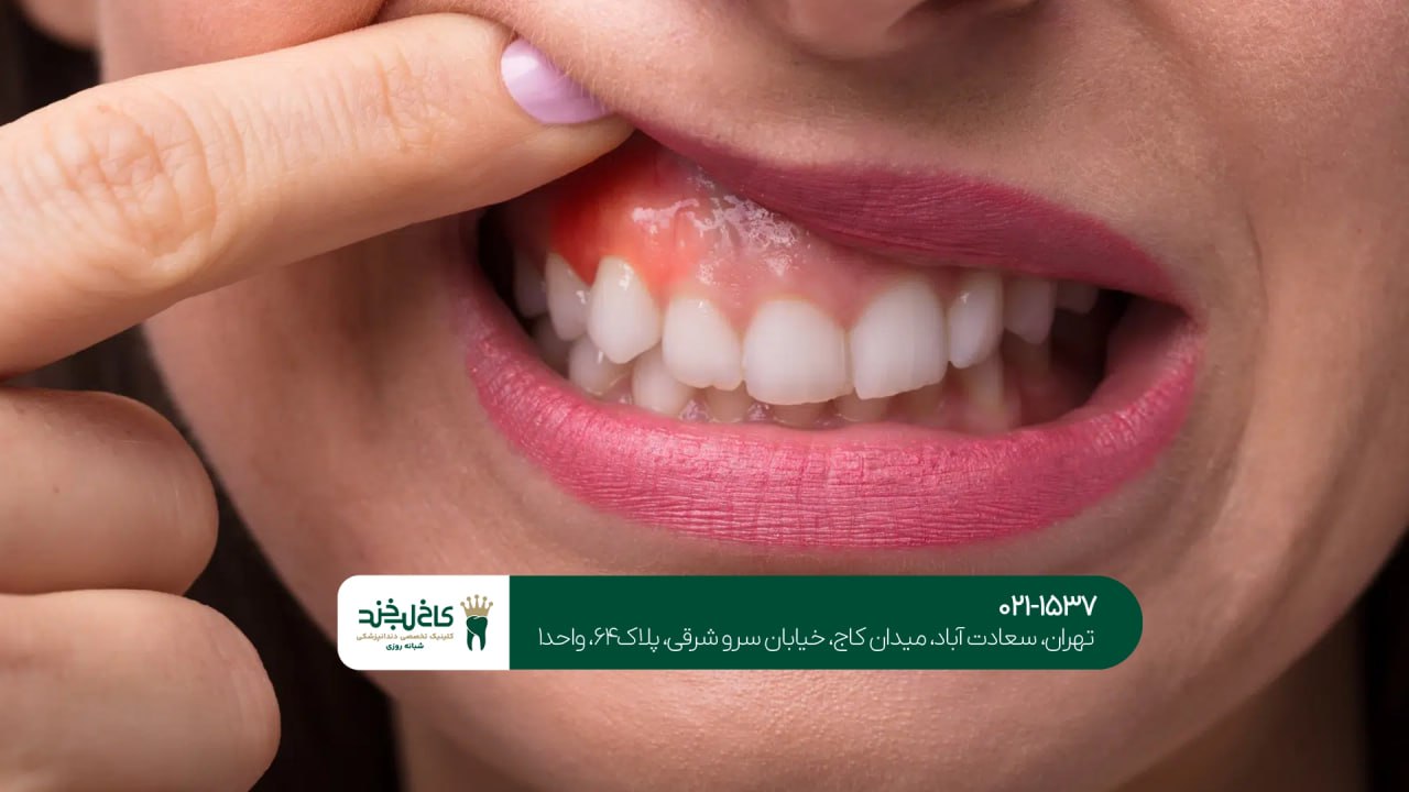 درمان دندانهای حساس