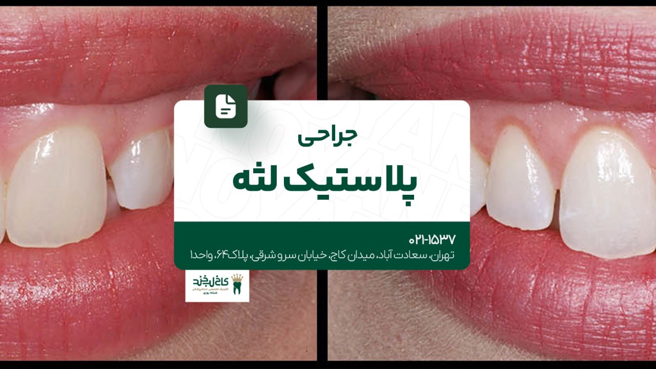 جراحی پلاستیک لثه