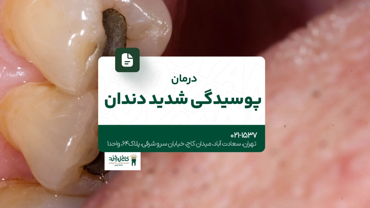 درمان پوسیدگی شدید دندان