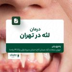 درمان لثه در تهران