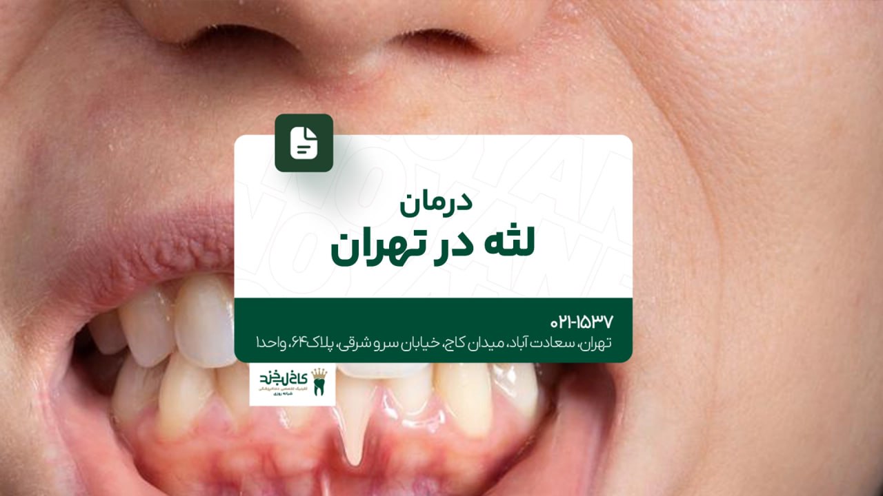 درمان لثه در تهران
