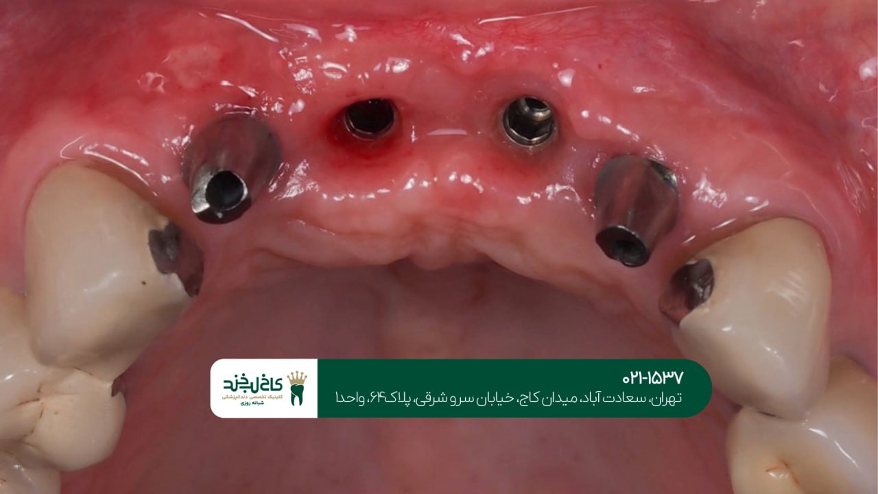 ایمپلنت فوری بدون درد