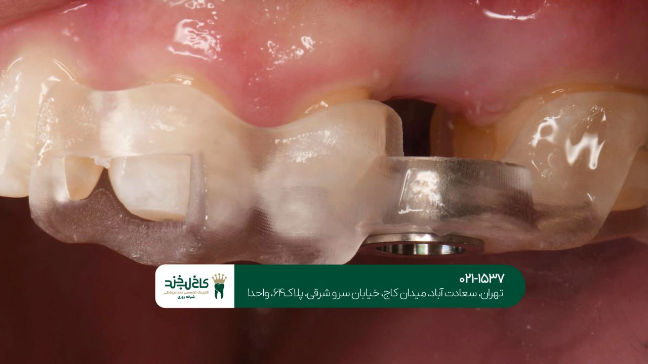 ایمپلنت دندان یک روزه