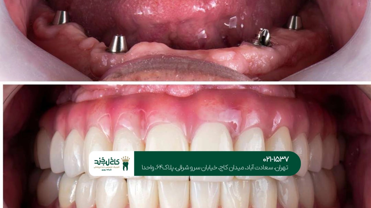 اصلاح طرح لبخند
