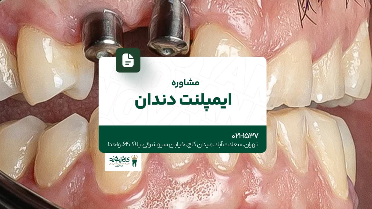 مشاوره ایمپلنت دندان