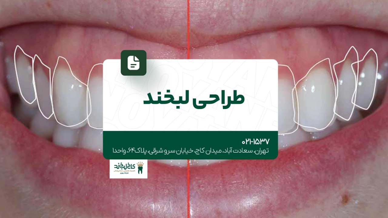 طراحی لبخند