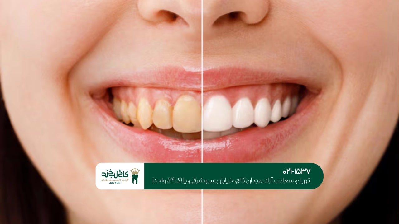 اصلاح رنگ دندان زرد
