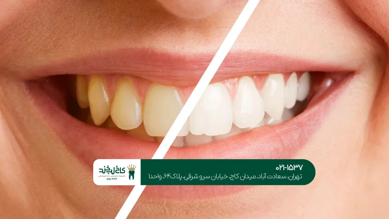 اصلاح رنگ دندان زرد