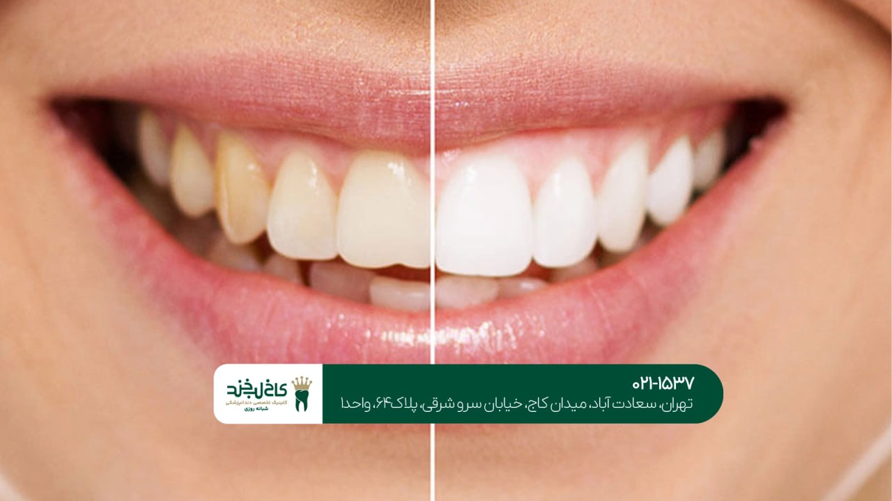 اصلاح رنگ دندان زرد