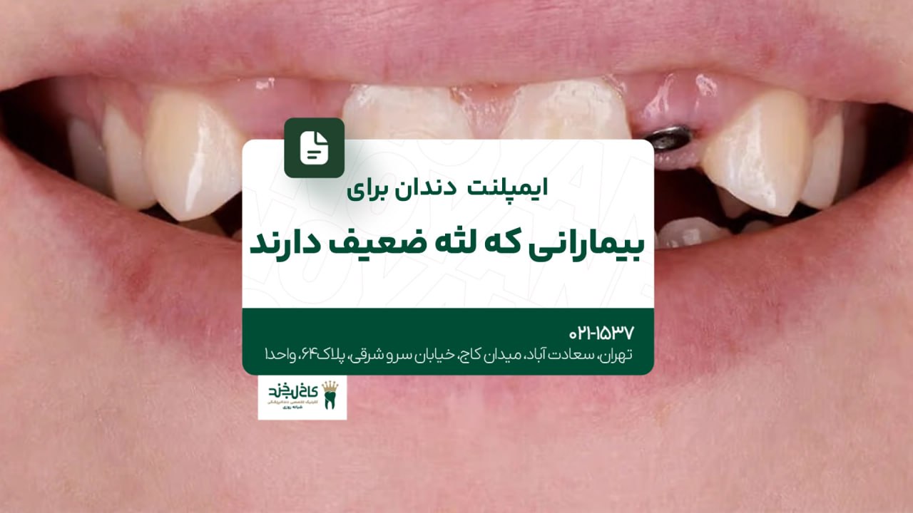 ایمپلنت دندان برای بیمارانی که لثه ضعیف دارند