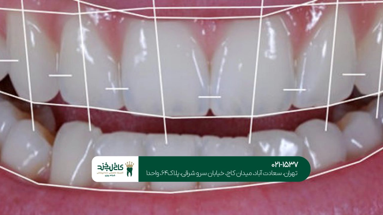 اصلاح طرح لبخند