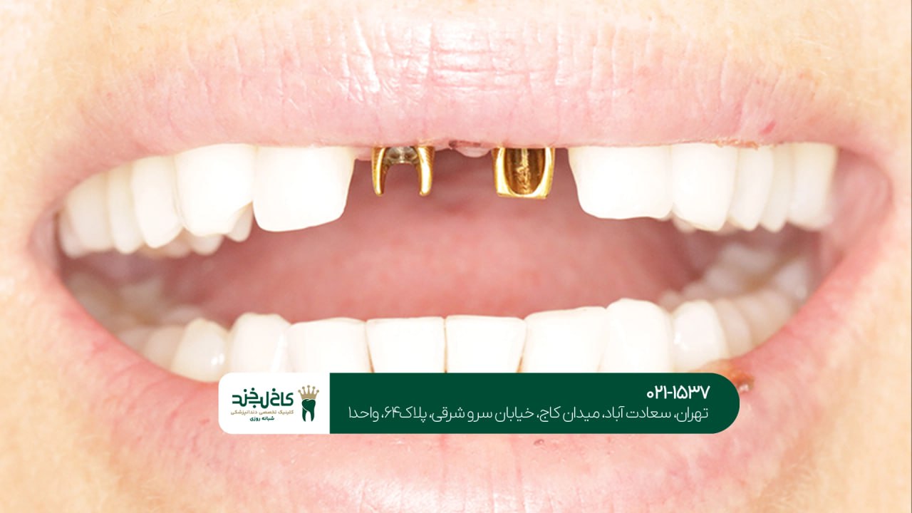 ایمپلنت دندان برای بیمارانی که لثه ضعیف دارند