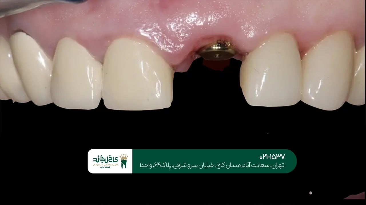ایمپلنت دندان برای بیمارانی که لثه ضعیف دارند