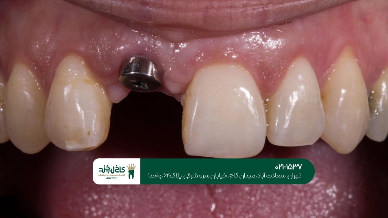 ایمپلنت دندان برای بیمارانی که لثه ضعیف دارند