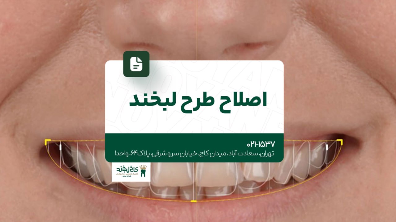 اصلاح طرح لبخند