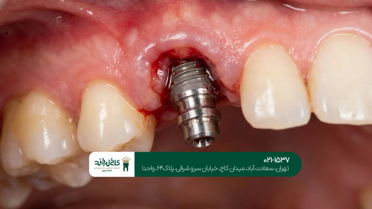 ایمپلنت دندان با تکنولوژی دیجیتال ایمپلنت دندان با تکنولوژی دیجیتال