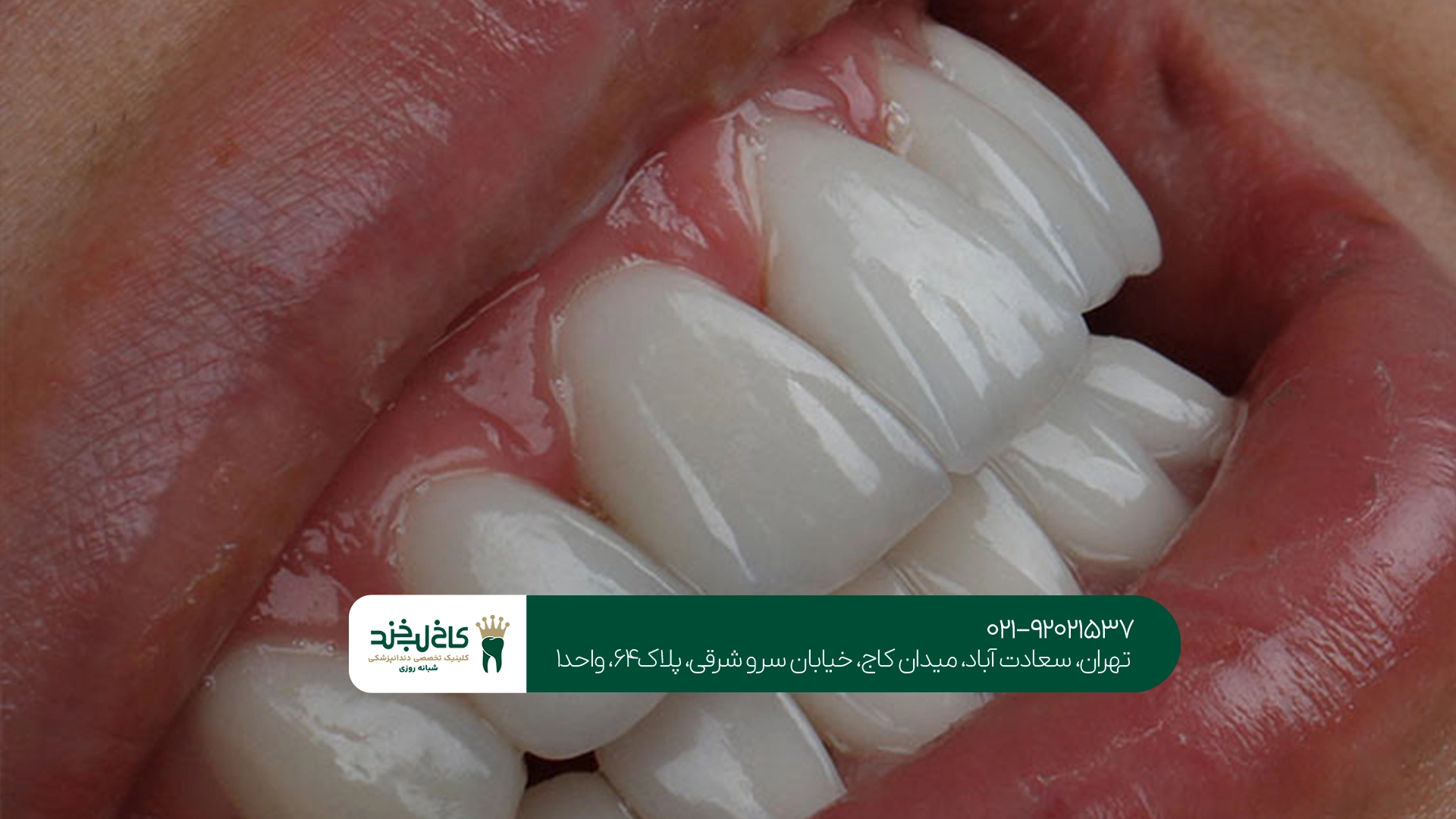 دندانپزشکی زیبایی تهران دندانپزشکی زیبایی تهران
