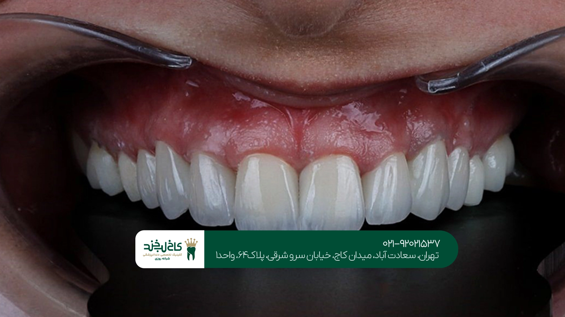 کامپوزیت و لمینت در تهران کامپوزیت و لمینت در تهران