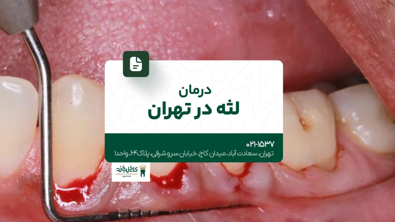 درمان لثه در تهران درمان لثه در تهران