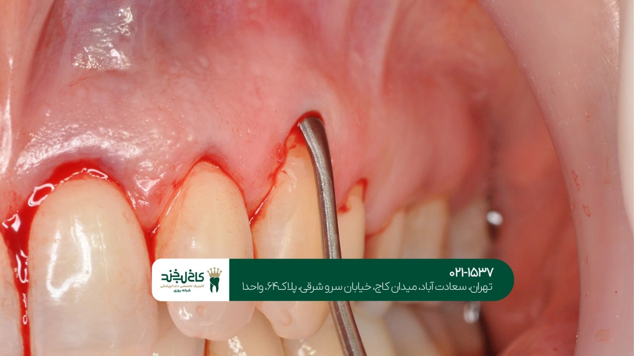 درمان لثه در تهران درمان لثه در تهران