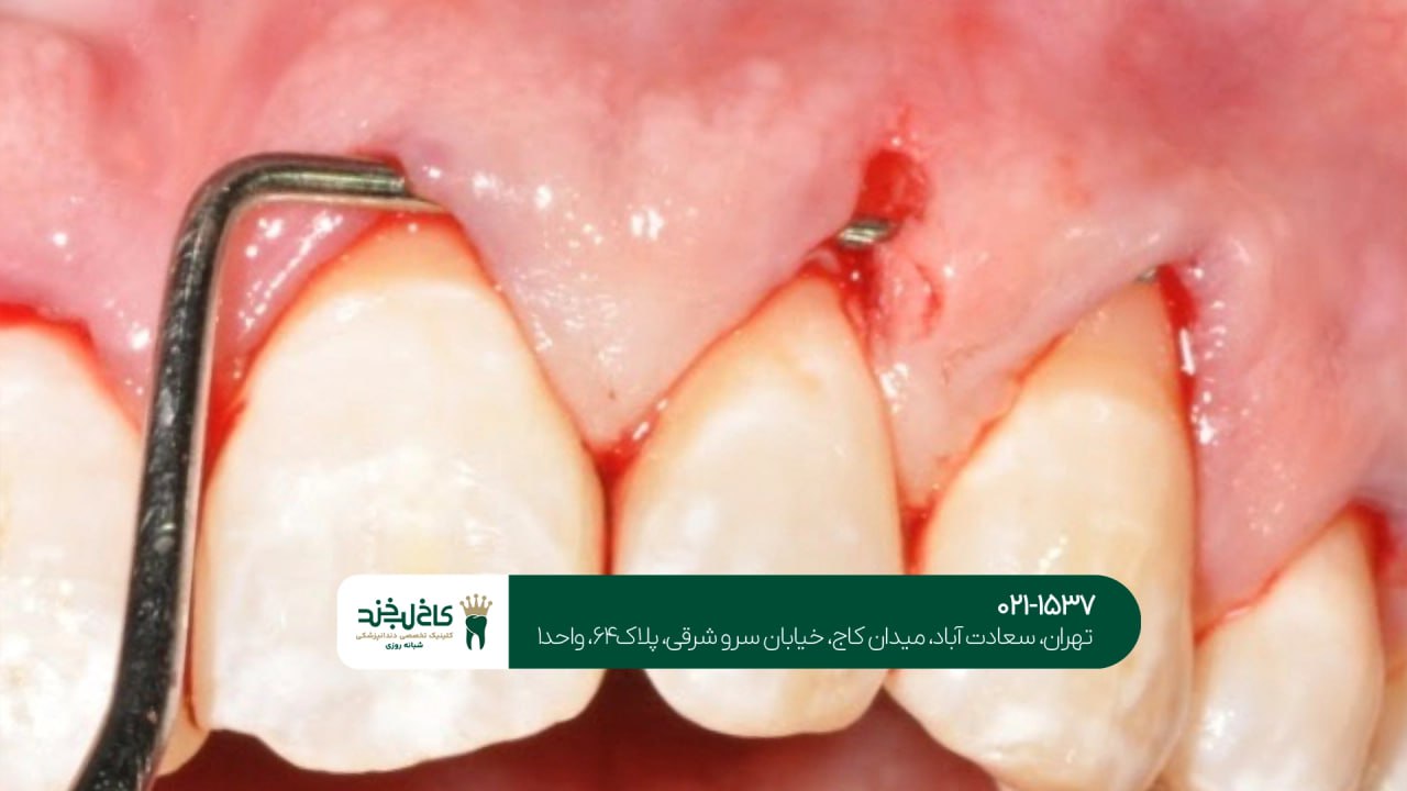 درمان لثه در تهران درمان لثه در تهران