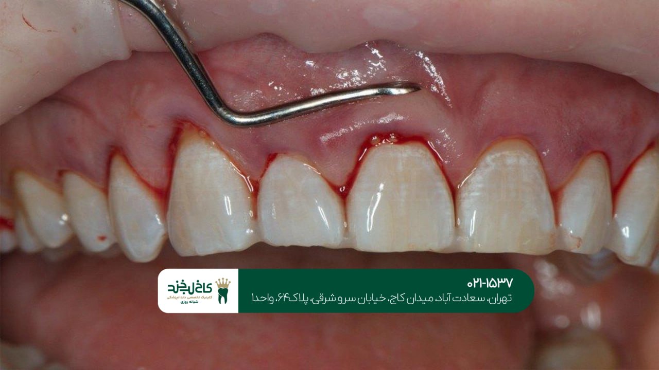 درمان لثه در تهران درمان لثه در تهران